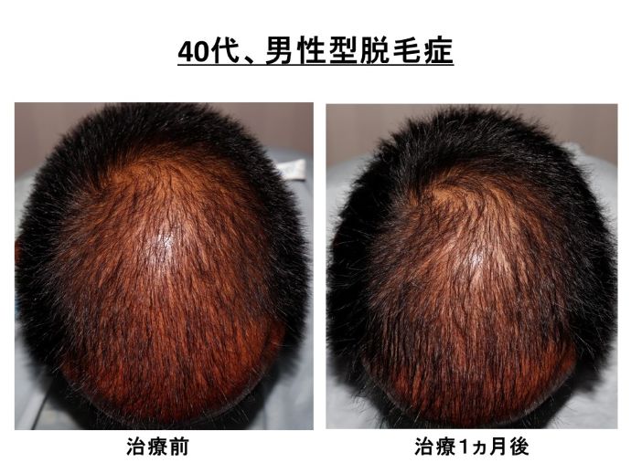 円形脱毛症　病院